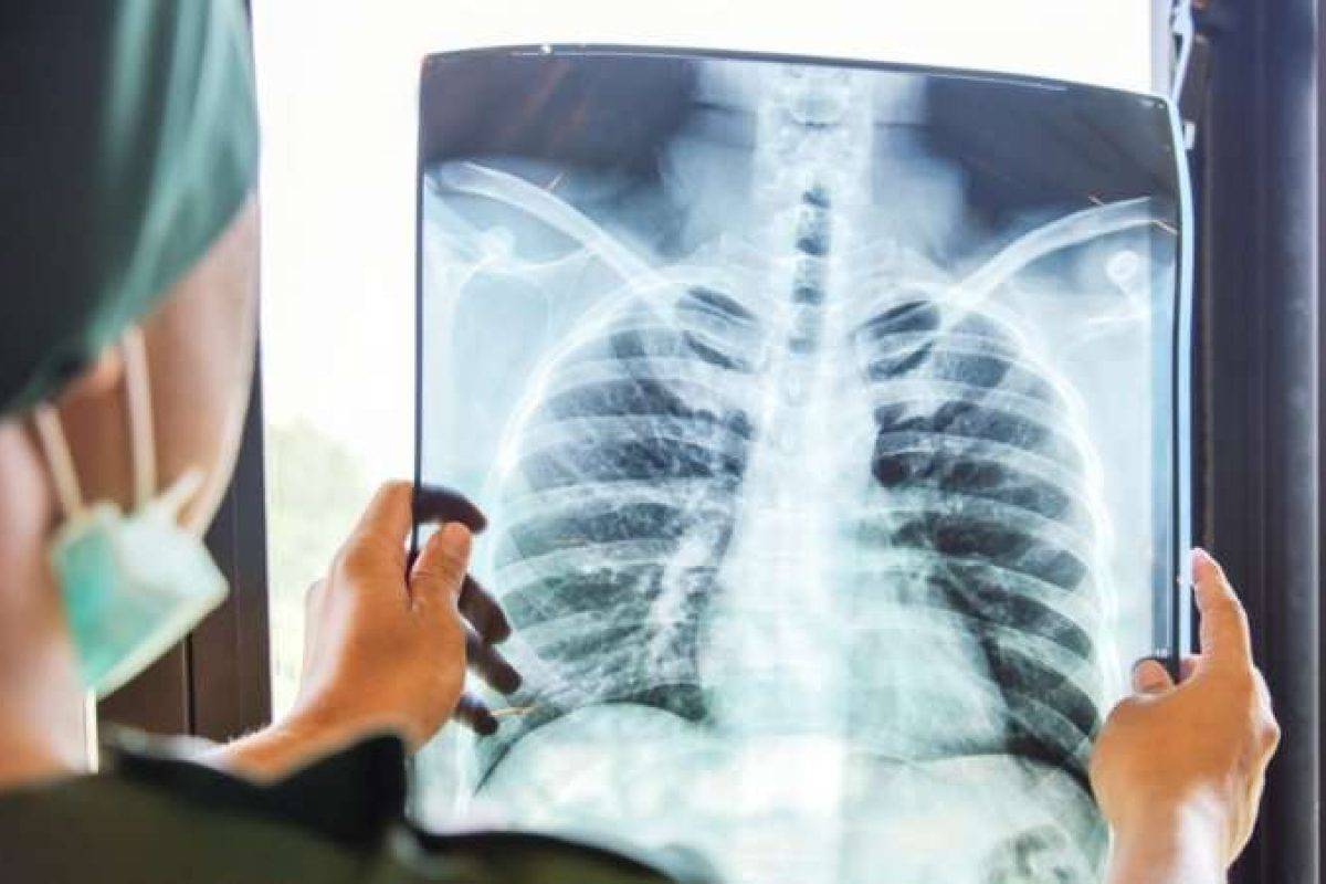 فحوصات مرض السل