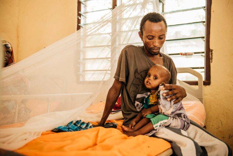 طفل يعاني الجوع في الصومال