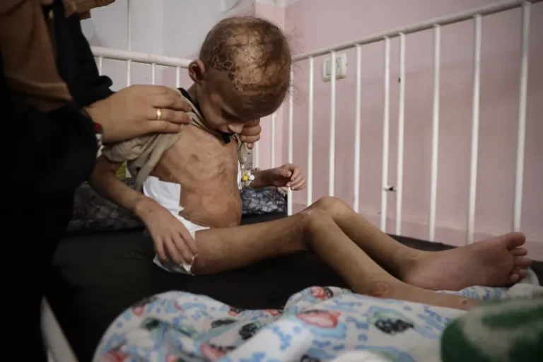 نحو 45 ألف طفل أُصيبوا خلال حرب الإبادة في غزة